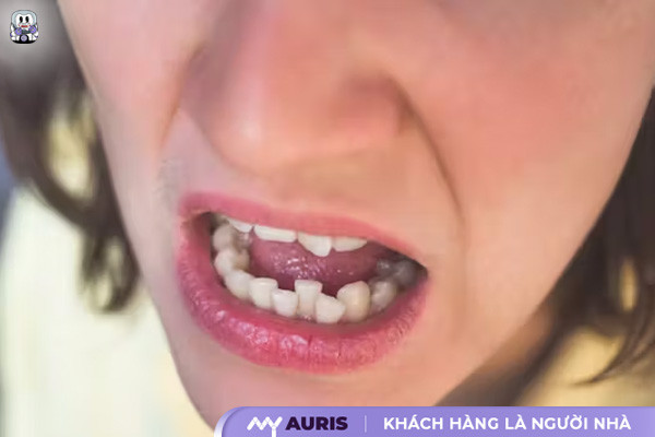 cách làm răng đều không cần niềng tại nhà