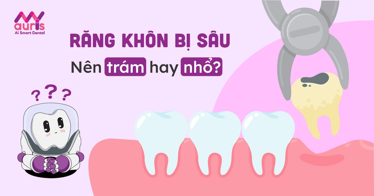 Răng khôn bị sâu: nên trám hay nên nhổ để tránh nguy hiểm?