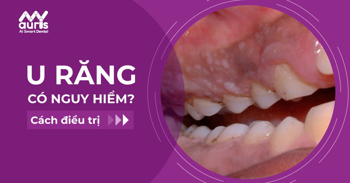 Những triệu chứng u răng thường gặp