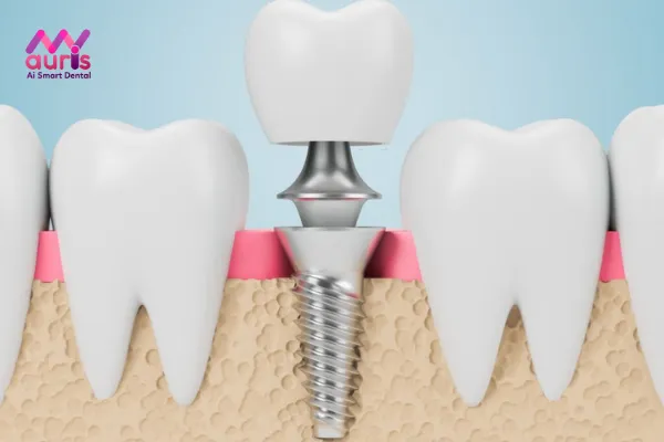 Ưu điểm, nhược điểm của phương pháp trồng răng Implant