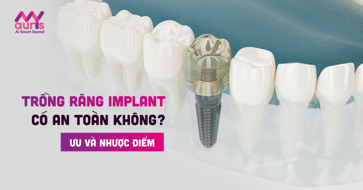 Giải đáp trồng răng implant có an toàn không