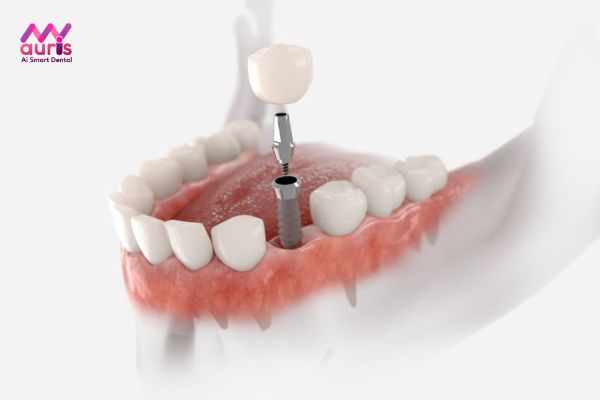 Yếu tố ảnh hưởng tuổi thọ trồng răng Implant