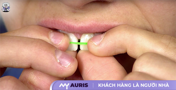 cách niềng răng thưa tại nhà