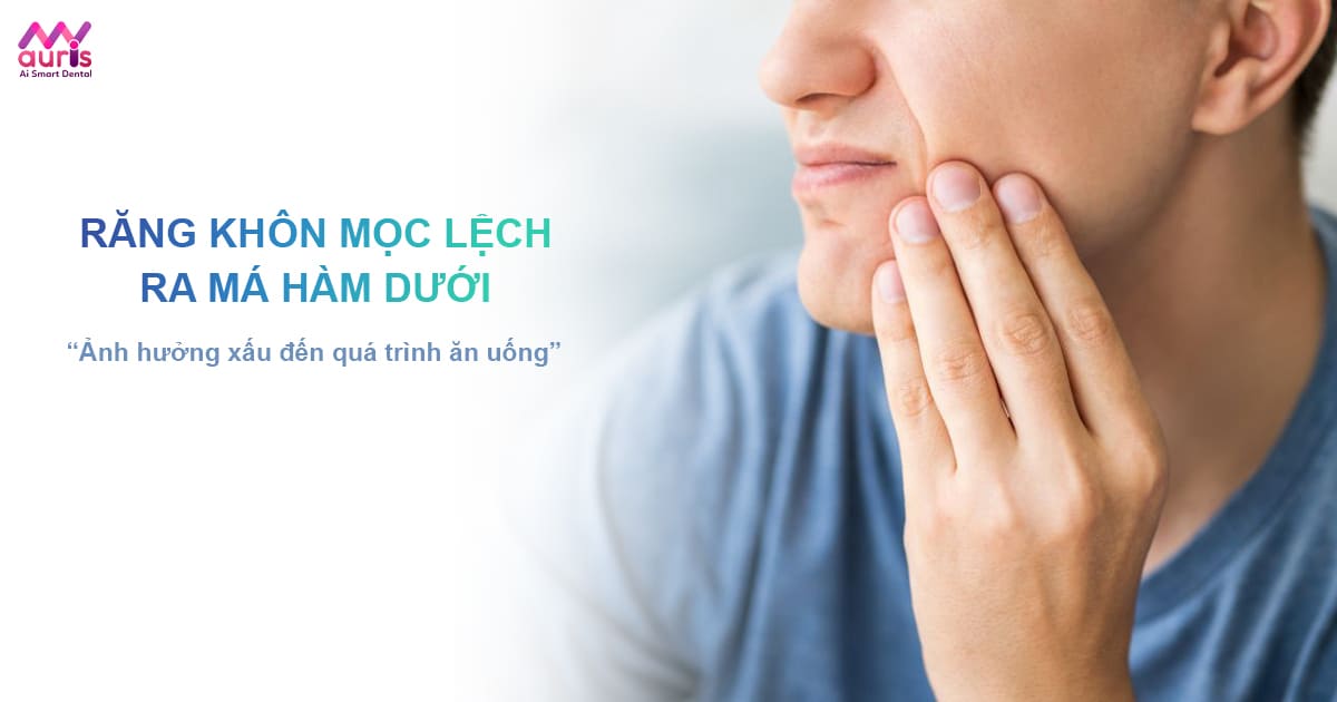 răng khôn mọc lệch ra má hàm dưới,rang khon moc lech ra ma ham duoi