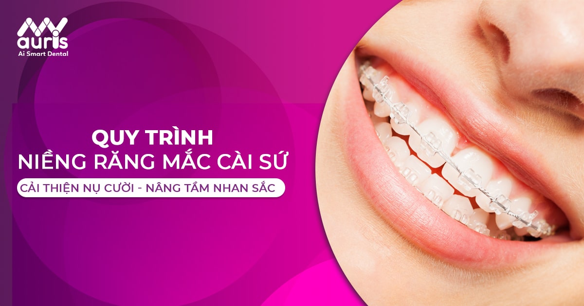 Tìm hiểu quy trình niềng răng mắc cài sứ