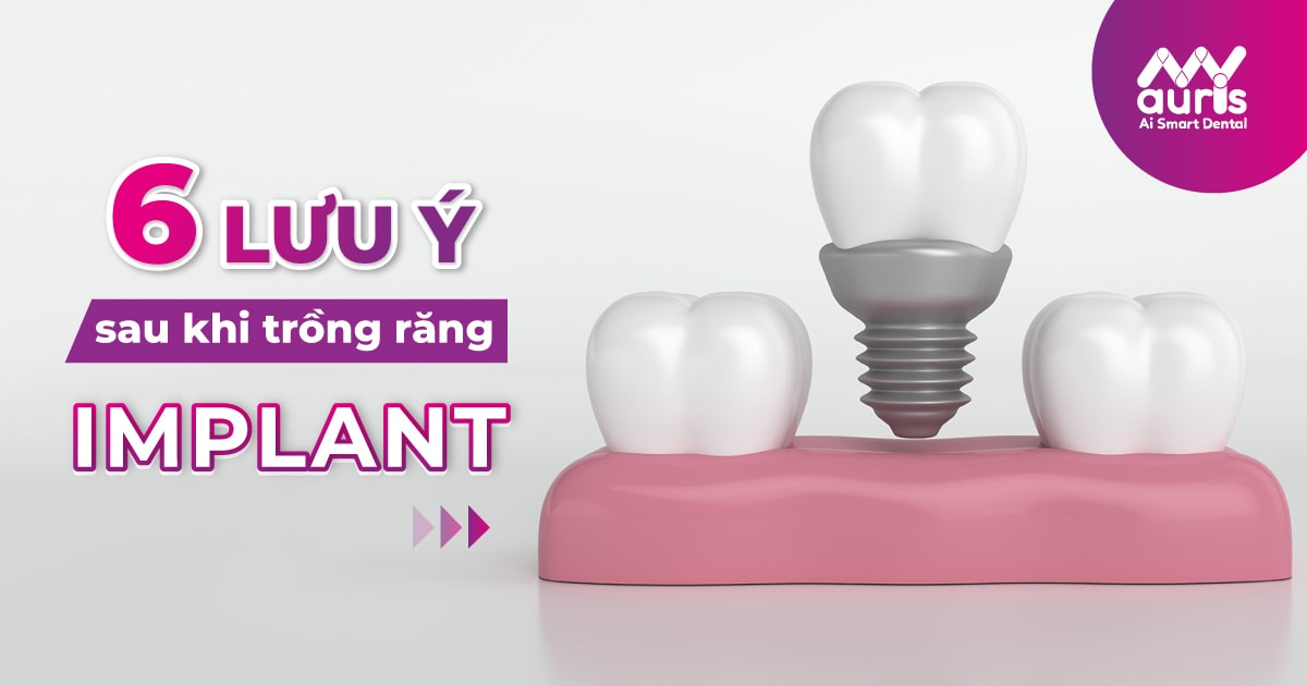 lưu ý sau khi trồng răng implant