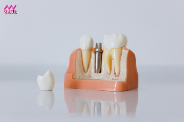 Trồng implant là phương pháp khắc phục tình trạng tiêu xương hàm hiệu quả - mất răng bao lâu thì bị tiêu xương hàm