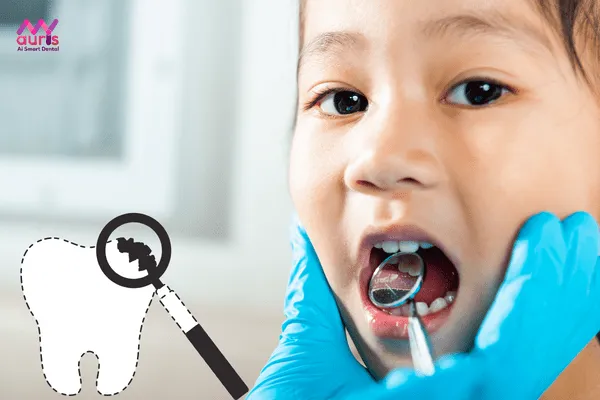 Bé 3 tuổi bị sâu răng hàm có sao không? 