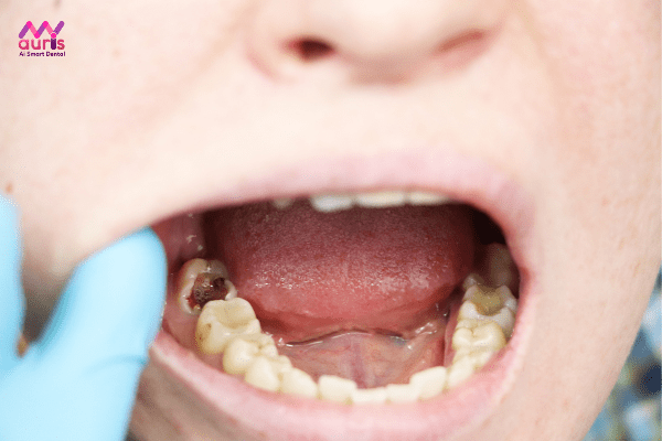 Bé 4 tuổi bị sâu răng hàm phải làm sao? 