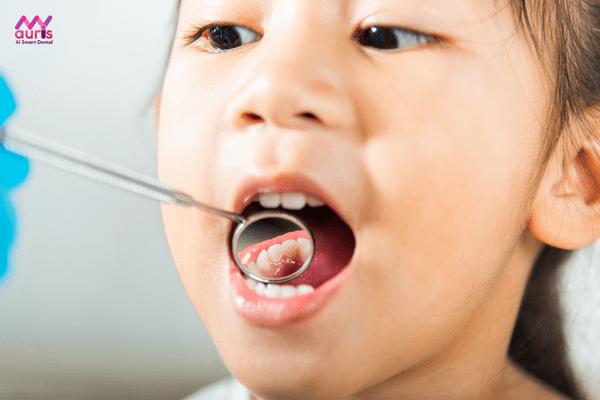 Dấu hiệu bé 5 tuổi bị sâu răng hàm phải làm sao