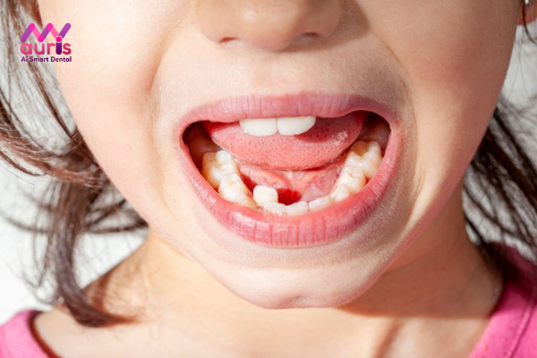 Hiện tượng răng mọc lệch ở trẻ