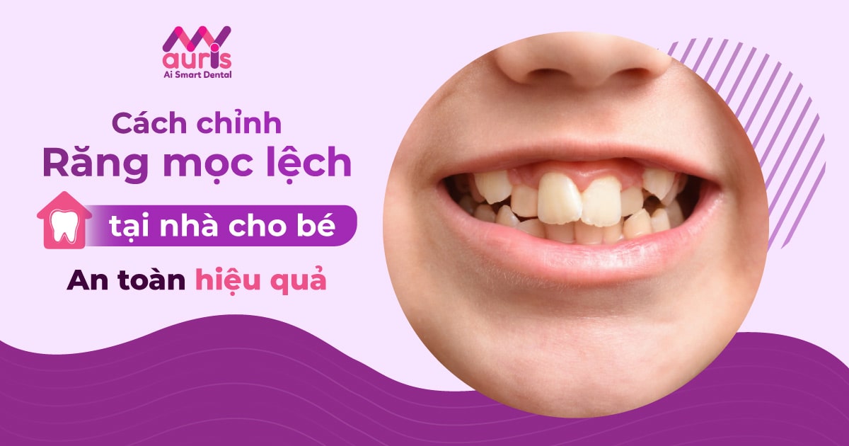 Cách chỉnh răng mọc lệch tại nhà cho bé mà ba mẹ cần tìm hiểu