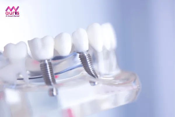 Trồng răng implant toàn hàm là gì? 
