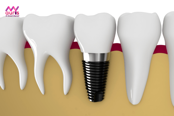 Ưu điểm của cấy ghép implant toàn hàm 