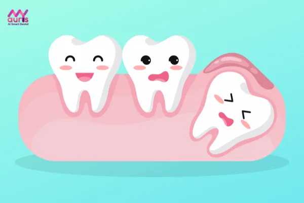 Trường hợp nào nên nhổ răng khôn hàm trên - nhổ răng khôn hàm trên có nguy hiểm không?