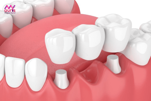Cầu răng sứ khắc phục hậu quả của mất răng số 6 sớm