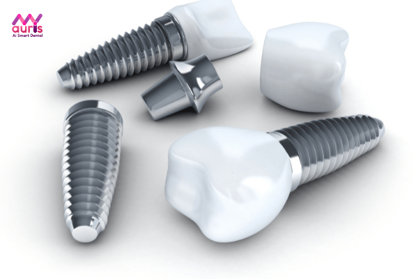 Cấy ghép implant khắc phục Cầu răng sứ khắc phục hậu quả của mất răng số 6 sớm