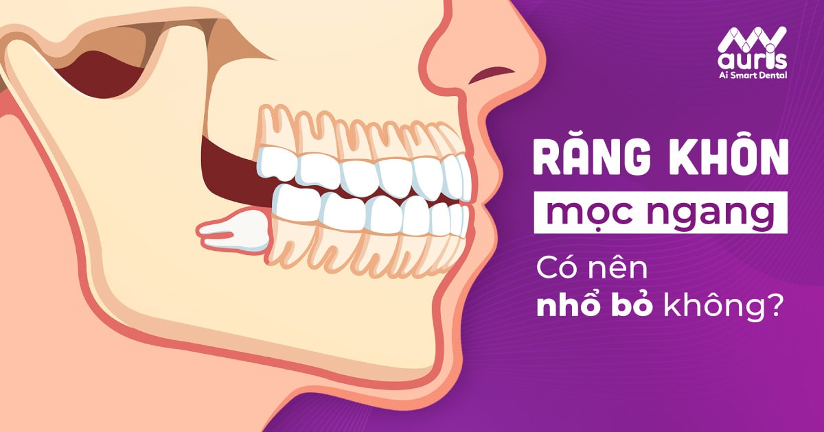 Răng khôn mọc ngang có nên nhổ và những tác hại không ngờ đến