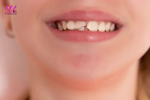 Nguyên nhân dẫn đến gãy răng 
