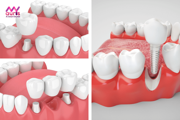 Các phương pháp phục hình cho răng bị gãy 