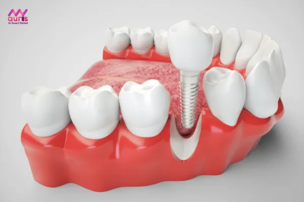 Phương pháp trồng implant khắc phục mất răng số 7 hàm dưới