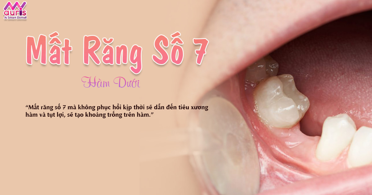 mất răng số 7 hàm dưới