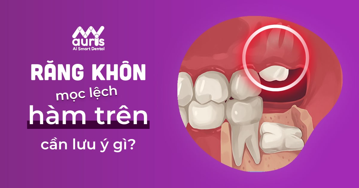 Nhận biết răng khôn mọc lệch hàm trên và cần lưu ý gì khi điều trị