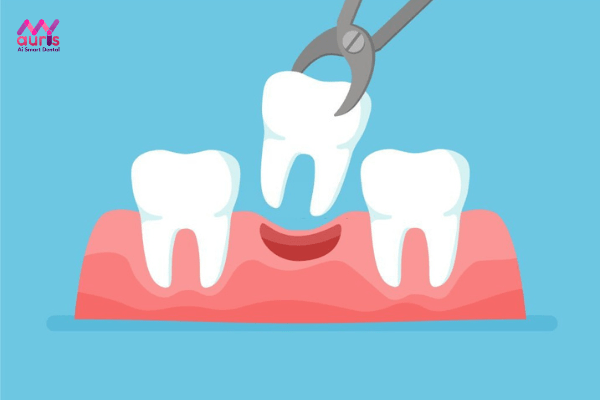 Nhổ răng hàm trên trong cùng bị sâu 