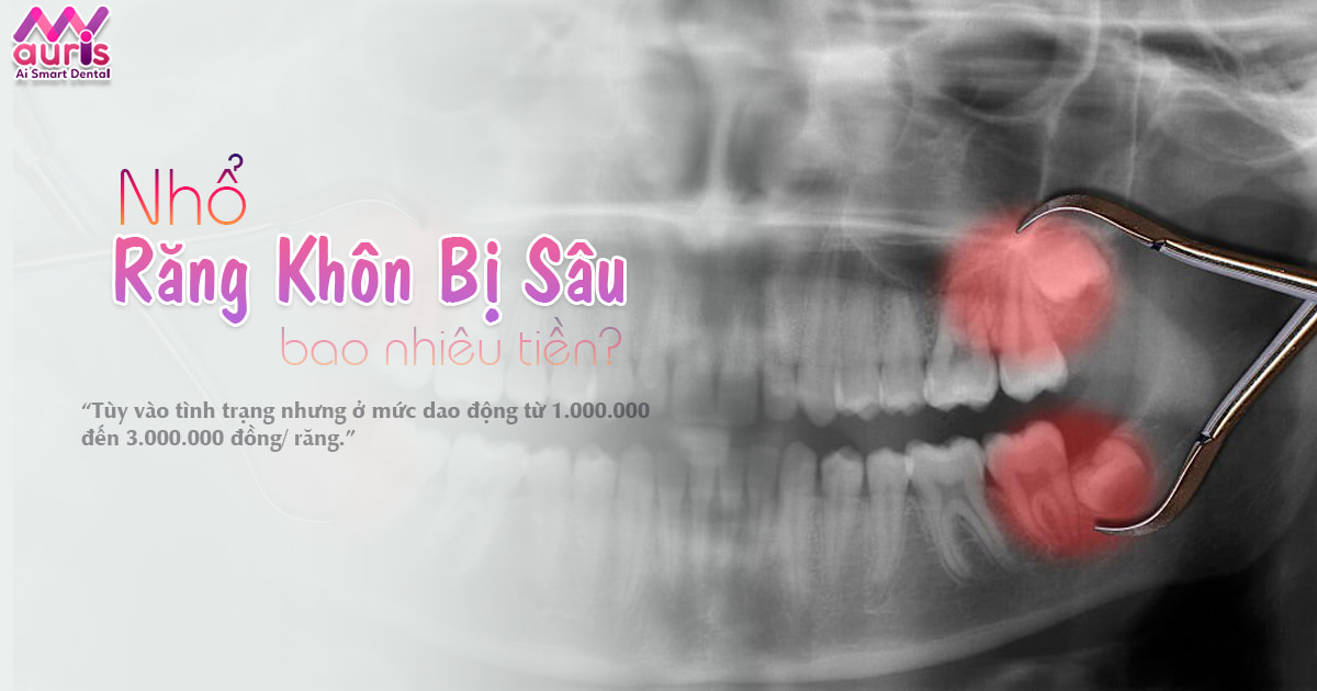 nhổ răng khôn bị sâu bao nhiêu tiền