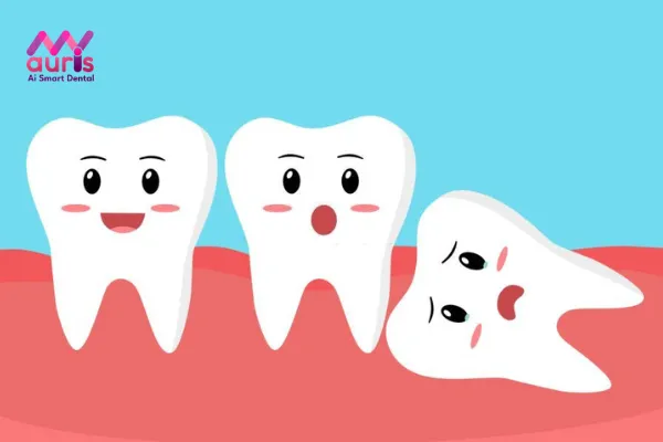 Nhổ răng khôn mọc lệch 90 độ bao nhiêu tiền?