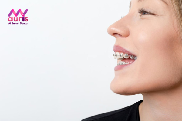 Niềng răng cho răng không đều bằng mắc cài kim loại