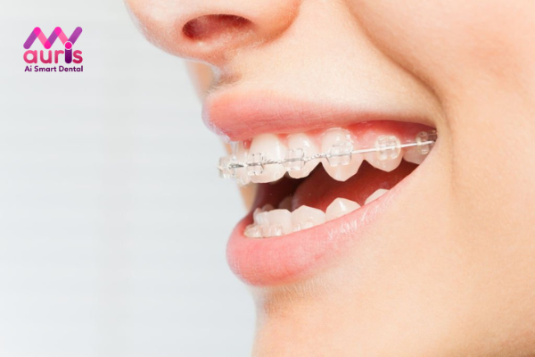 Niềng răng cho răng không đều bằng mắc cài sứ