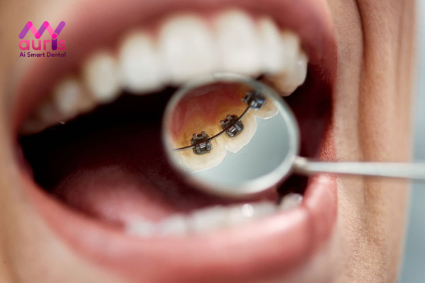 Niềng răng cho răng không đều bằng mắc cài mặt trong