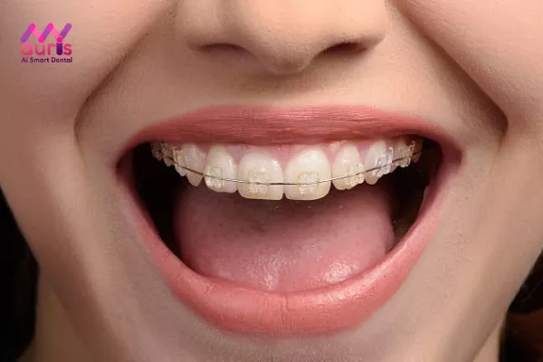 Niềng răng móm như thế nào bằng niềng răng mắc cài sứ