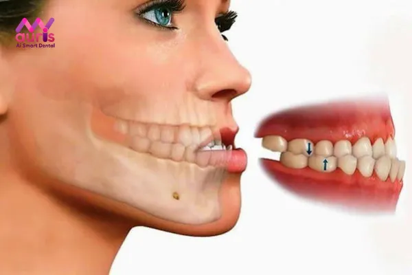 Tìm hiểu về tình trạng răng móm