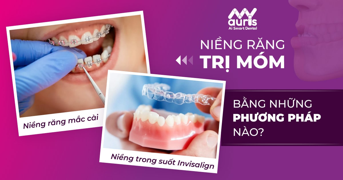 Niềng răng trị móm là gì và những điều cần biết