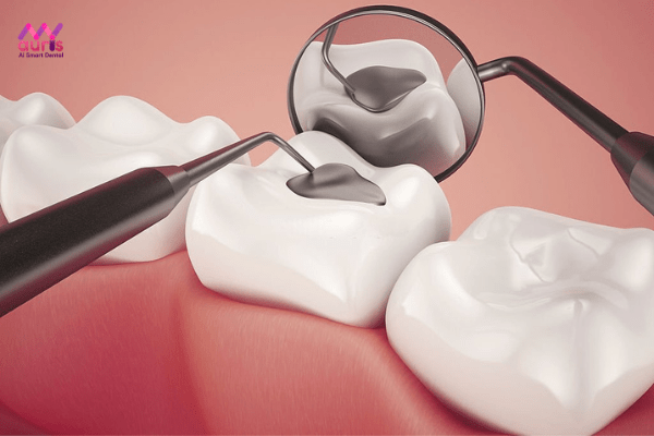 Răng bị sâu lỗ to có trám được không? 
