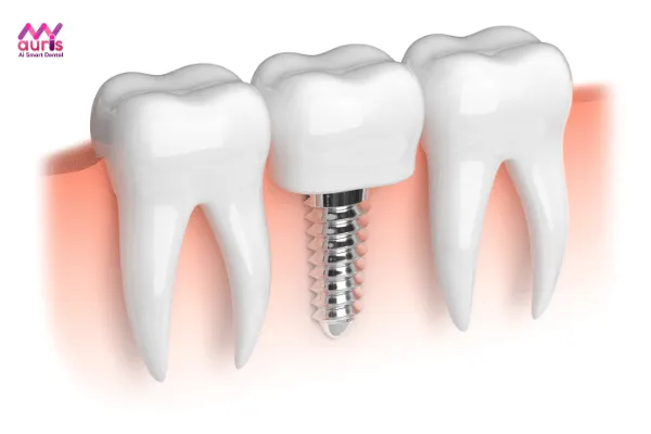 Nhổ răng bị sâu lỗ to phải làm sao? Cấy ghép implant phục hình răng đã mất 