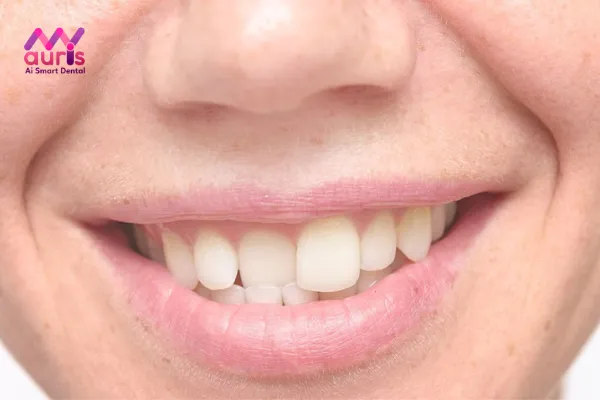Nguyên nhân gây răng cửa hàm trên mọc lệch vào trong