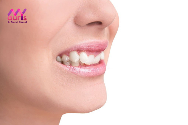 Ảnh hưởng của răng cửa hàm trên mọc lệch vào trong