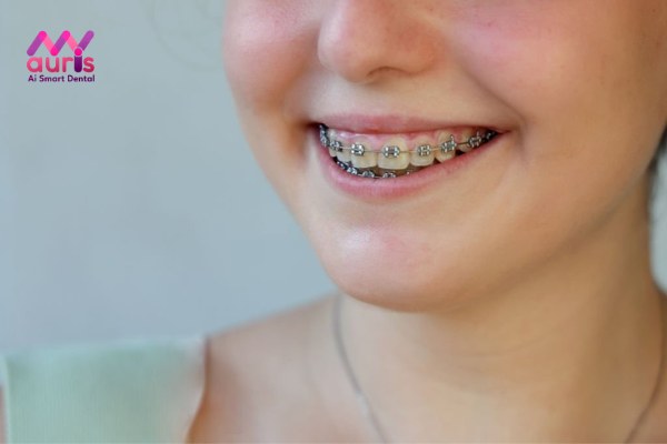 Điều trị răng mọc lệch vào trong bằng cách niềng răng