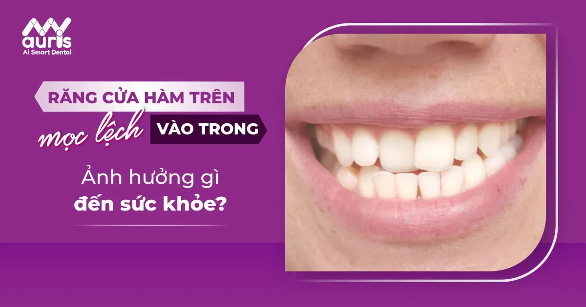 Răng cửa hàm trên mọc lệch vào trong là gì?
