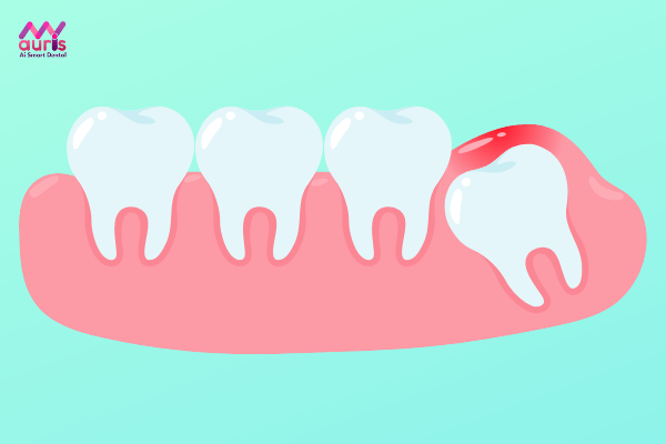 Tại sao răng khôn hàm trên mọc lệch ra má? 