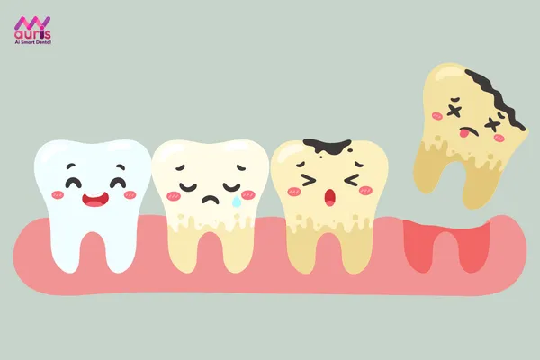 Biến chứng do răng khôn gây ra - Răng khôn là răng số mấy