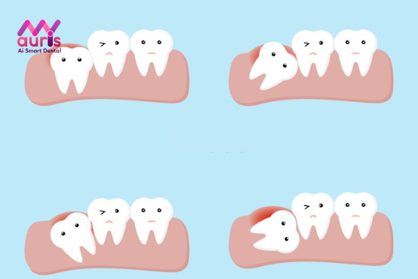 Tìm hiểu răng khôn là gì?
