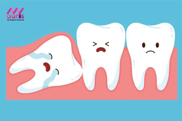 Những biến chứng răng khôn mọc ngầm trong xương gây ra