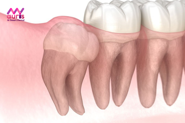 Tìm hiểu răng khôn mọc ngầm trong xương 