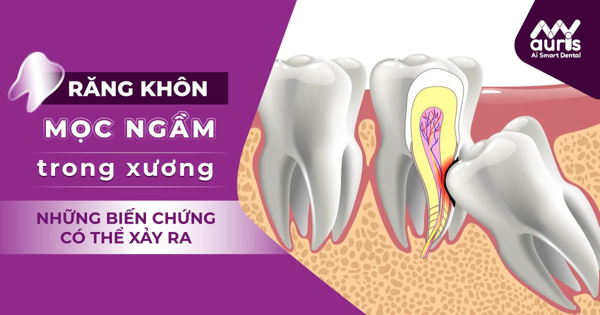 Răng khôn mọc ngầm trong xương và những điều cần lưu ý