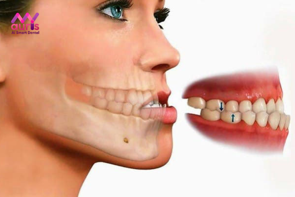 Tìm hiểu niềng răng móm trong bao lâu?