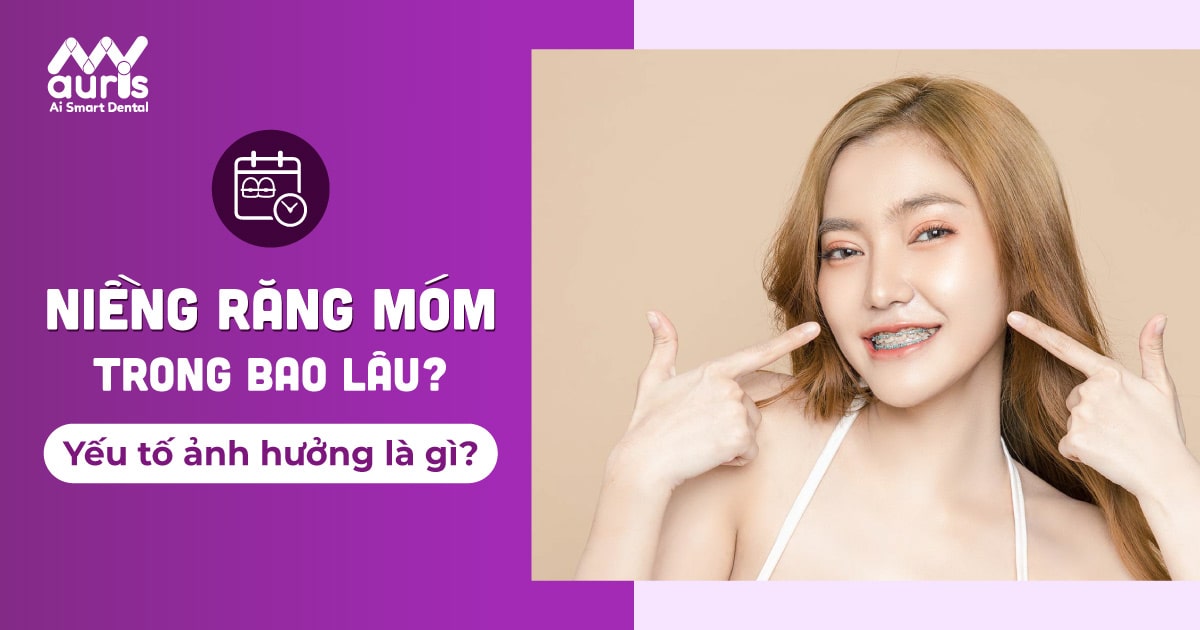 Niềng răng móm trong bao lâu và yếu tố ảnh hưởng